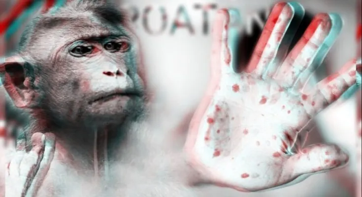 Malas noticias para Roatán: Salud confirma 2 nuevos casos de viruela del mono