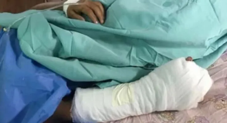 Hombre pierde tres dedos tras explotarle mortero en Intibucá