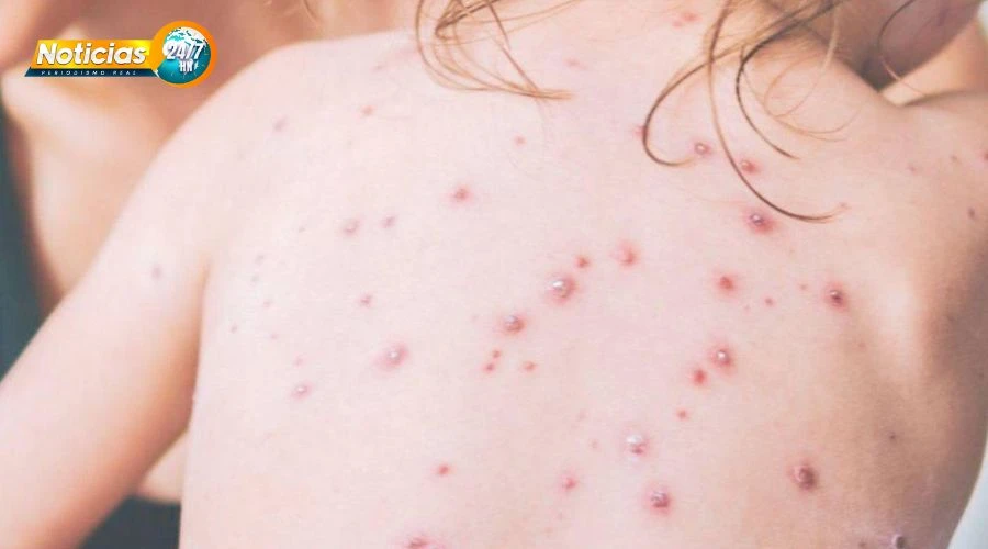 ¡ATENCIÓN! Emiten alerta epidemiológica por riesgo de introducción de casos importados de sarampión