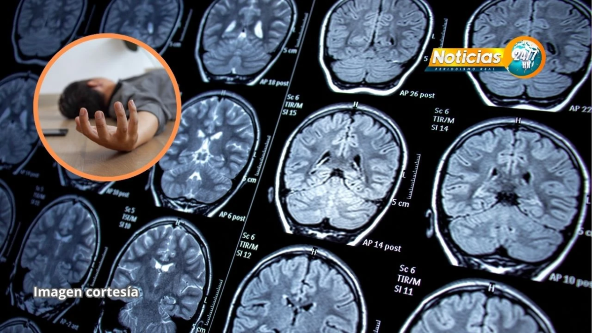 Epilepsia Afecta A Uno De Cada 100 Hondurenos Y La Cifra Sigue En Aumento