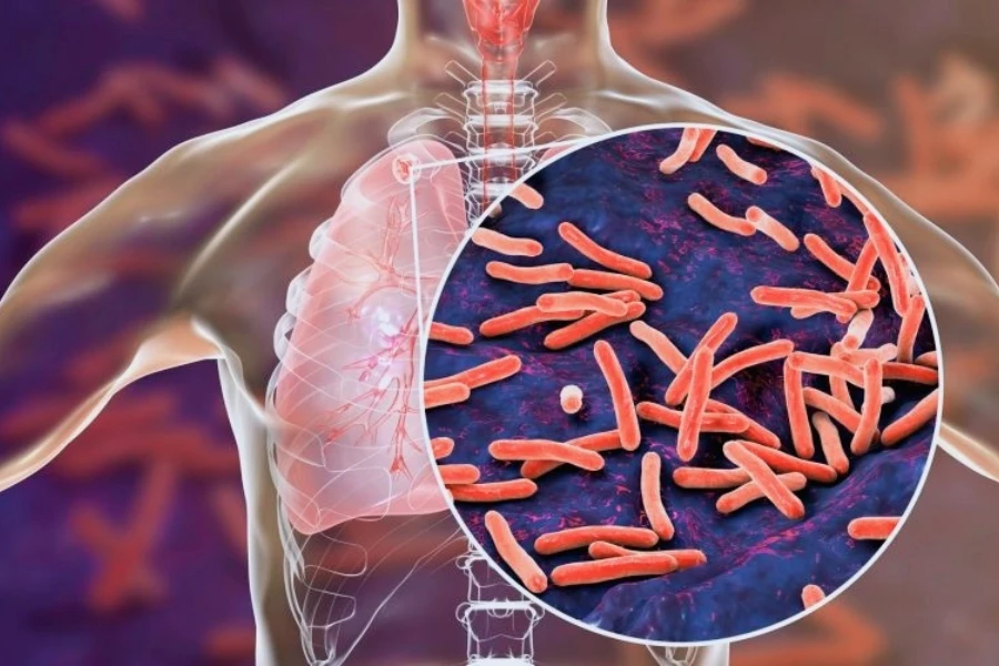 Realizan Feria Para Captacion De Casos Por El Dia Mundial De La Tuberculosis